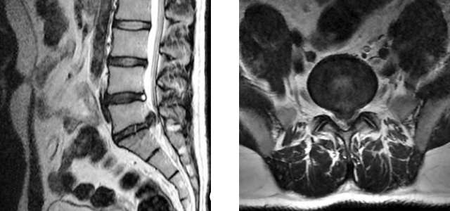 MRI shows herniation